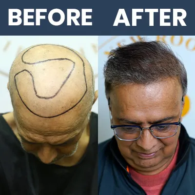 Hair Transplant