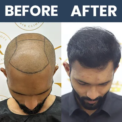 Hair Transplant