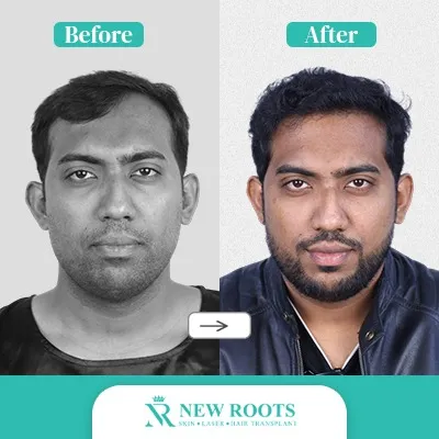 Hair Transplant