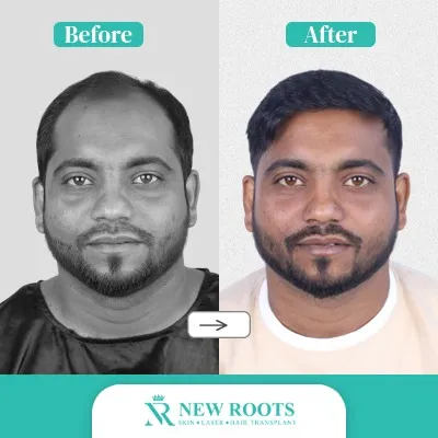 Hair Transplant