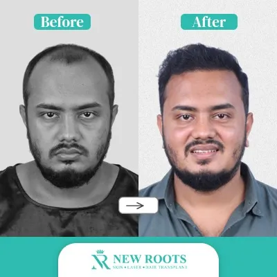 Hair Transplant
