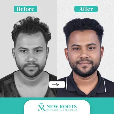 Hair Transplant