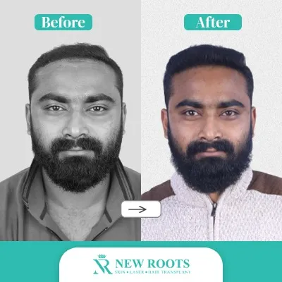 Hair Transplant