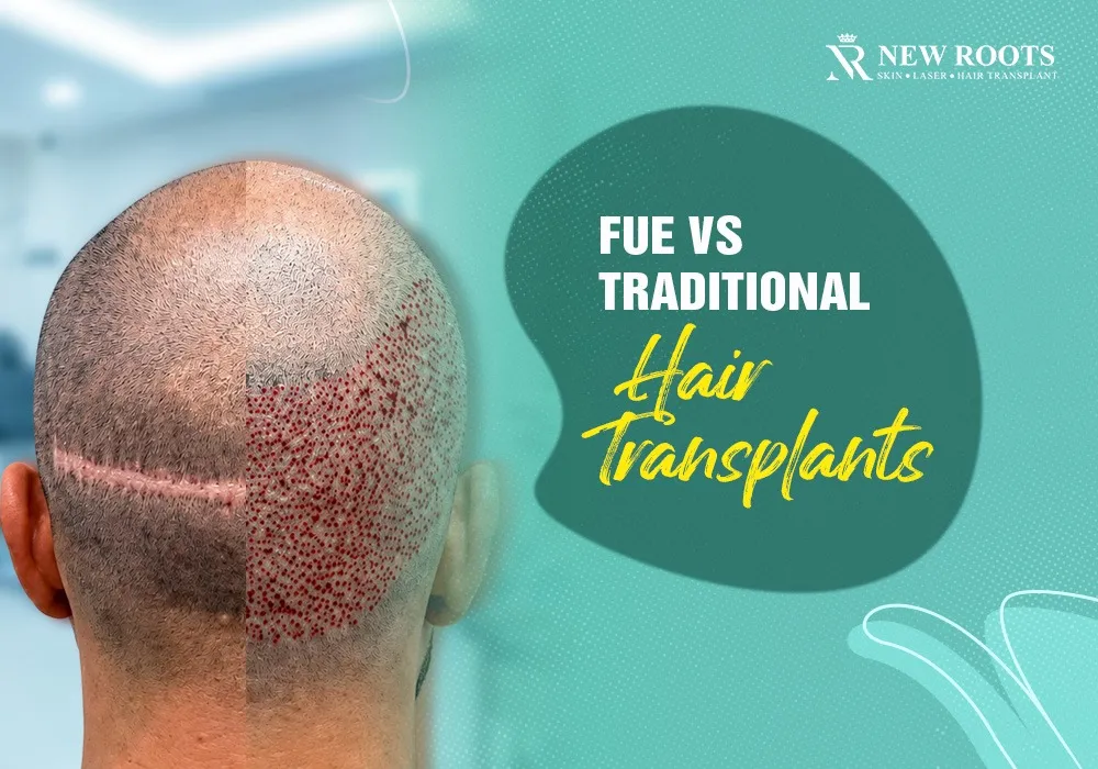 fue hair transplant