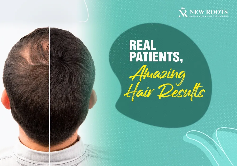 Hair Transplant Before and After: Real Results & Photos