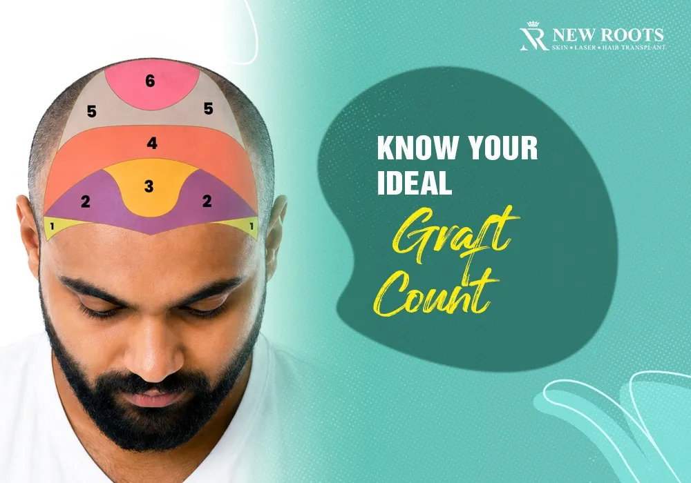 hair transplant grafts