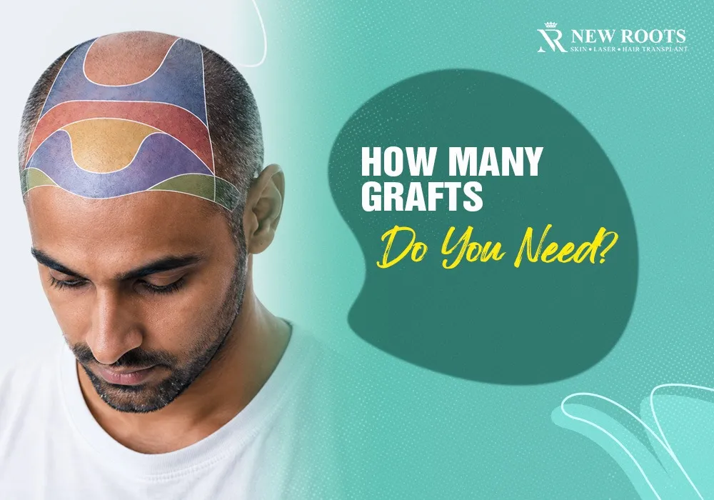 hair transplant density