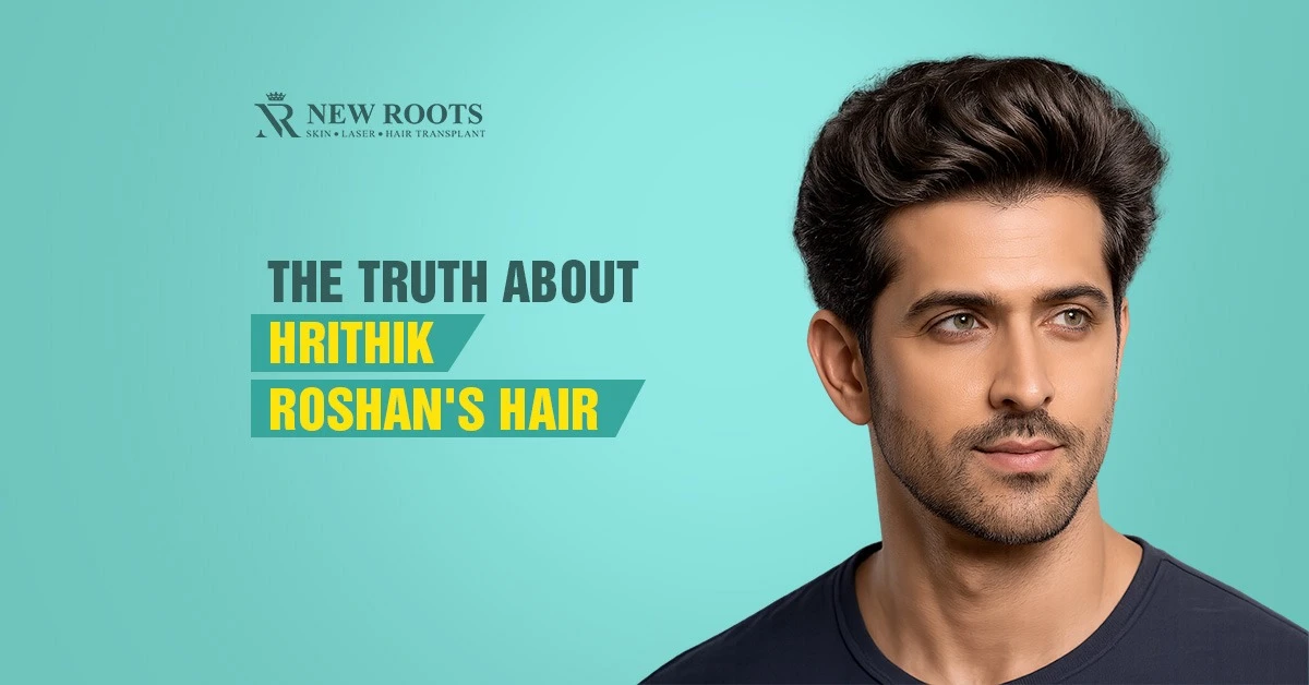hrithik roshan hair loss